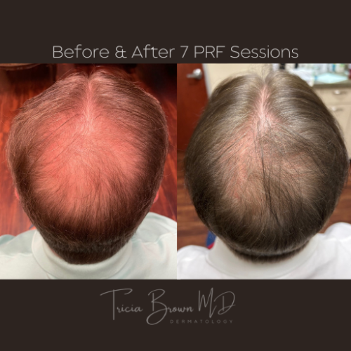 Before-and-after-PRF-2-