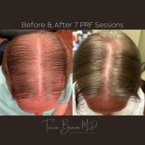 before-and-after-PRF-