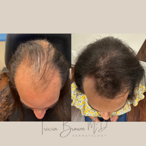 Hairloss-12